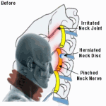 Лечебный надувной воротник для шеи при остеохондрозе шейного отдела